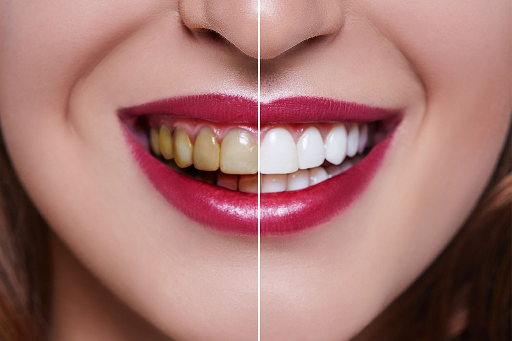 Dental veneers’ cost, procedure, and results